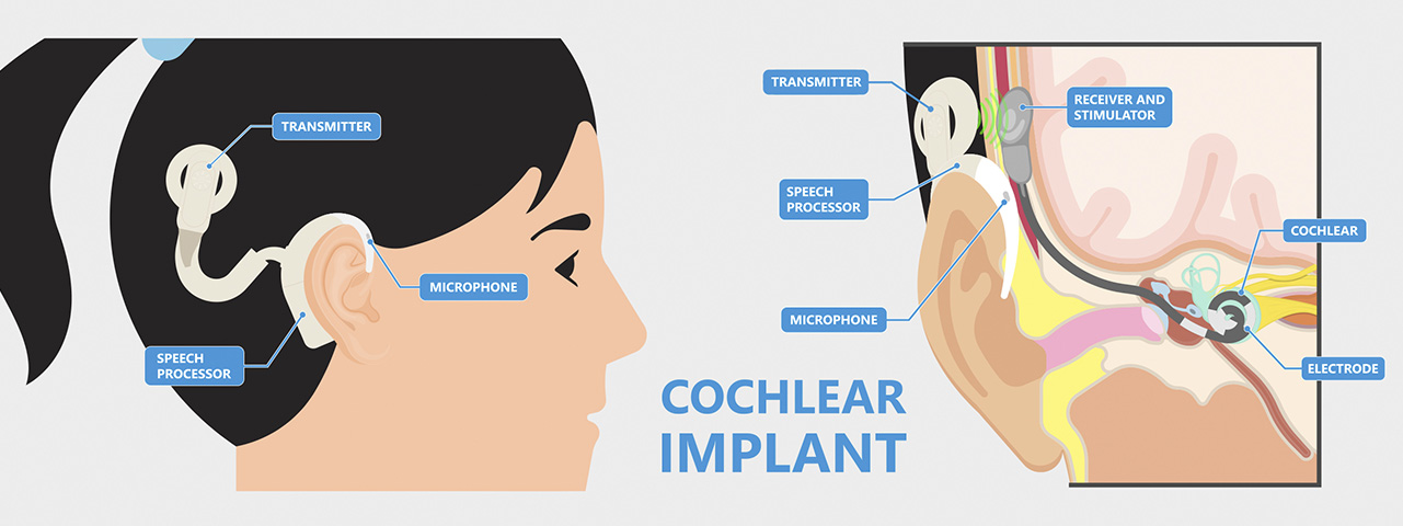 Grafik zur Erläuterung der Funktionsweise eines Cochela-Implantats